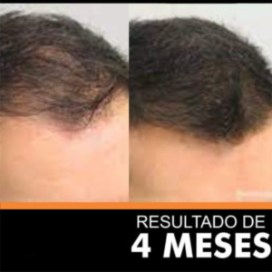 HAIR GROWTH - cauvirom 4m